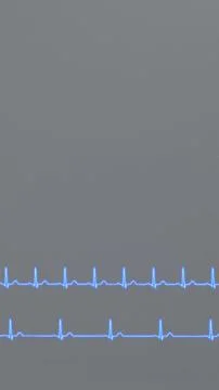 Comparison of ECG of normal heart rhythm and bradycardia. 库存照片
