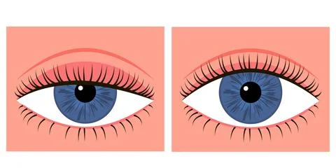 Comparison eye with down lid ptosis and healthy eye. Blepharoplasty, eyelid s Stock Illustration