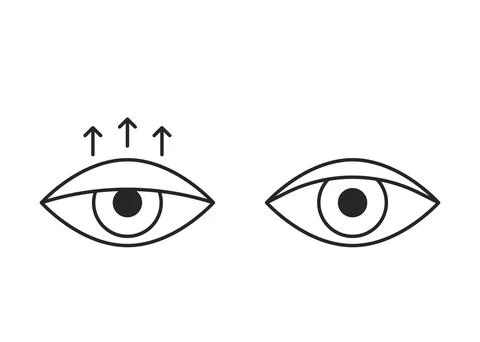 Comparison eye with down lid ptosis and healthy eyelid, line icon. Blepharopl Stock Illustration