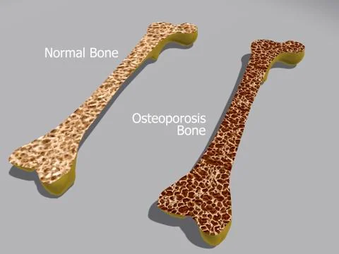 Comparison of a healthy bone and a bone with osteoporosis. Illustrazione stock