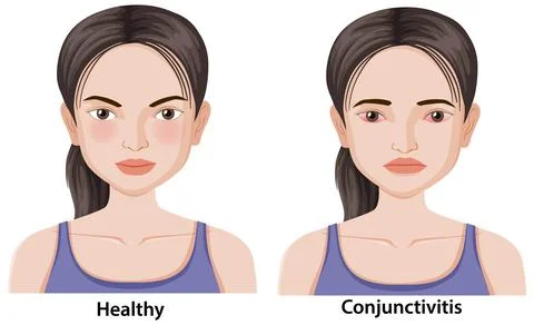 Comparison of Healthy Eye and Conjunctivitis Symptoms in Woman Stock Illustration