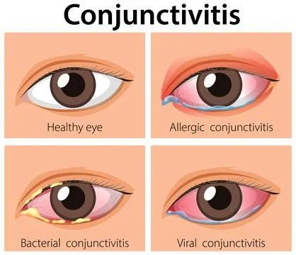 Comparison of Healthy Eye and Types of Conjunctivitis Stock Illustration