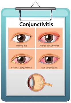 Comparison of Healthy Eye and Types of Conjunctivitis Stock Illustration