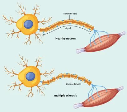 Comparison of Healthy Neuron and Multiple Sclerosis Damage Stock Illustration