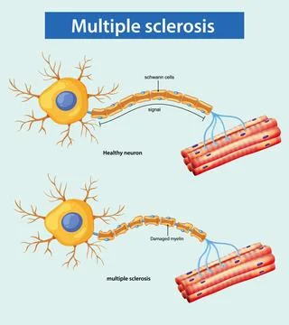 Comparison of Healthy Neuron and Multiple Sclerosis Damage Stock Illustration