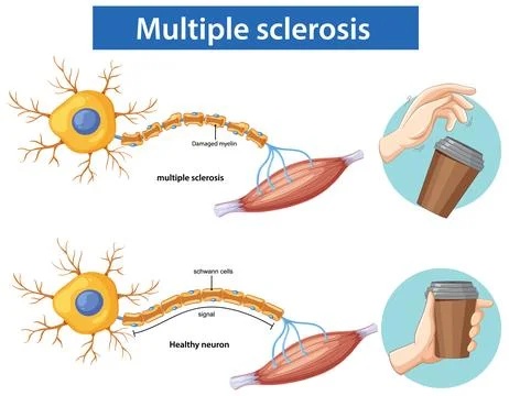 Comparison of Healthy Neuron and Multiple Sclerosis Effects Stock Illustration