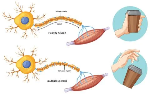 Comparison of Healthy Neuron and Multiple Sclerosis Effects Stock Illustration