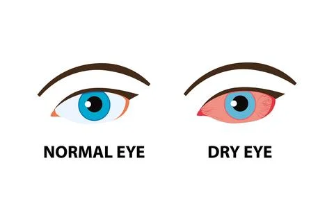 Comparison illustration between normal and dry eye Stock Illustration