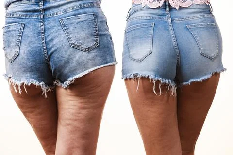 Comparison of legs with and without cellulite Stock Photos