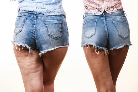 Comparison of legs with and without cellulite Stock Photos