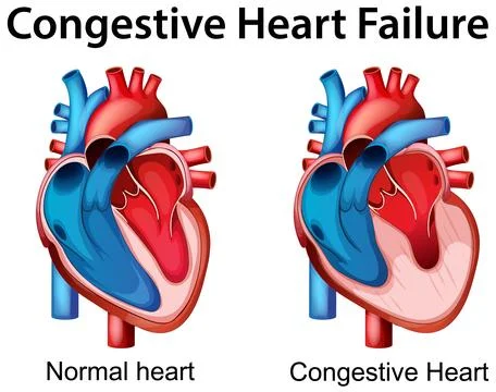 Comparison of Normal and Congestive Heart Illustration Stock Illustration