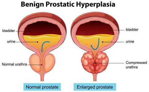 Comparison of Normal and Enlarged Prostate Glands Stock Illustration