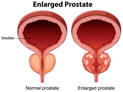 Comparison of Normal and Enlarged Prostate Anatomy Stock Illustration