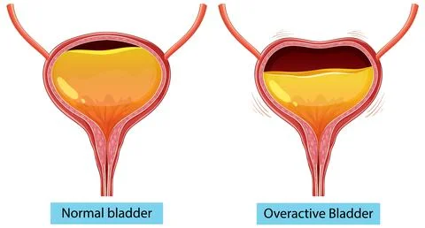 Comparison of Normal and Overactive Bladder イラスト素材