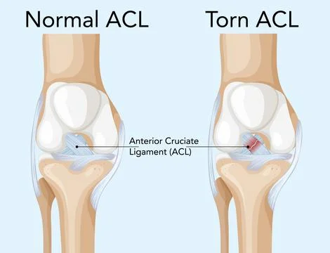 Comparison of Normal and Torn ACL Illustration Stock Illustration