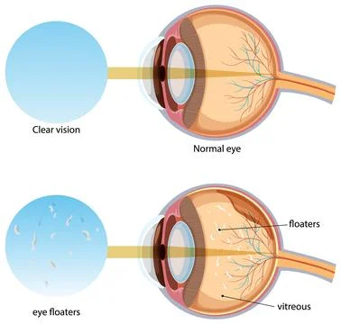 Comparison of Normal Eye and Eye Floaters Illustration Stock Illustration