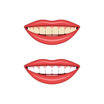 Comparison of yellow and white teeth before and after whitening treatment v.. Stock Illustration