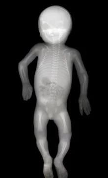 Complete X-ray Child Stock Photos
