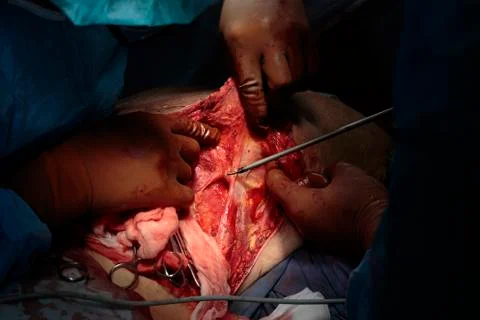 Complex back surgery Foto stock