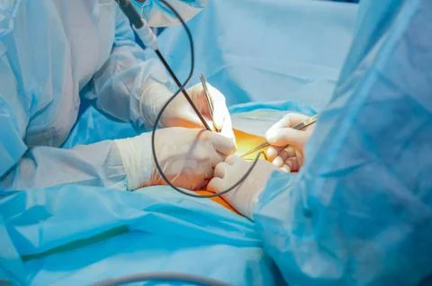 Complex laparoscopic operation on a peritoneal cavity is carried out in four Stock Photos