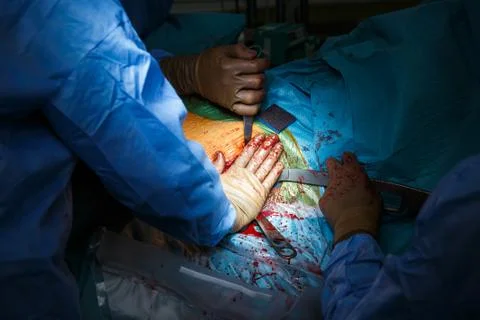 Complex surgery in progress, open bloody cavity 스톡 사진