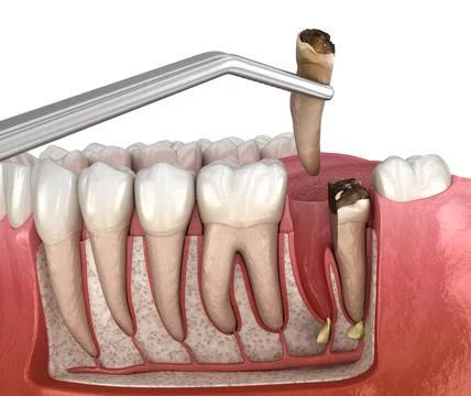 Complex tooth extraction. Medically accurate 3D illustration Stock Illustration