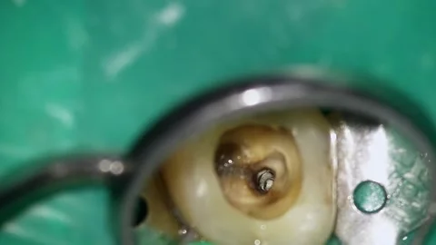 Comprehensive assessment focusing on progressive molar canal widening and Stock Footage 343961962