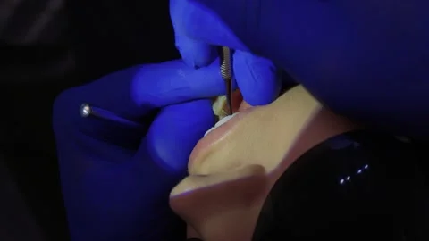 Comprehensive Dental Hygiene Procedure Conducted with a Specialized Dental Drill Stock Footage 319902452