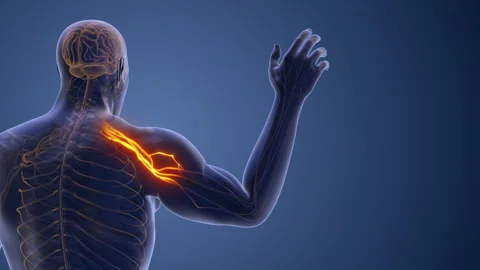 Compressed Cervical Nerve Leading to Radiating Pain Stock-Footage 304355350
