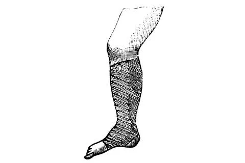 Compression Stocking – 1897 Original Vintage Engraved Illustration Stock Illustration