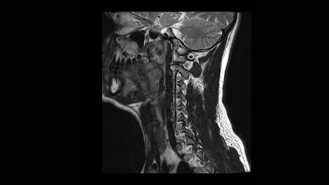 Computed medical tomography MRI scan of the cervical spine of a man with 库存影片 99281585