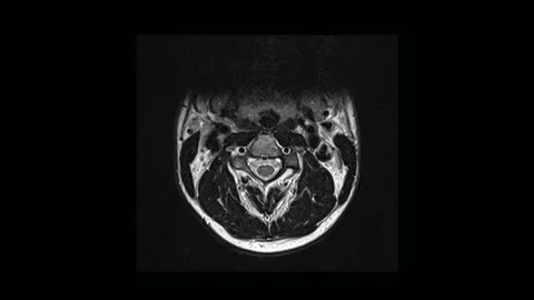 Computed medical tomography MRI scan of the cervical spine of a man with Stockbeeldmateriaal 99282380
