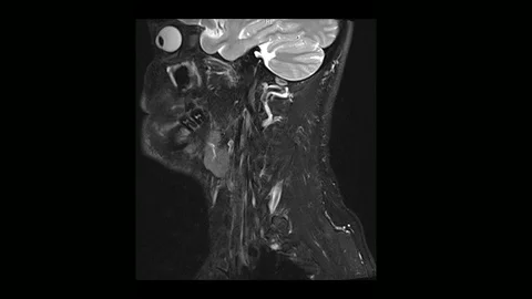 Computed medical tomography MRI scan of the cervical spine of a man with Stock Footage 99722147