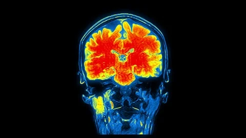 Computed Medical Tomography MRI Upscaled Scan of Healthy Young Female Head Stock Footage 92388896