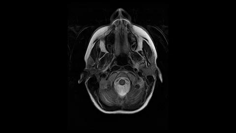 Computed Medical Tomography MRI Upscaled Scan of Healthy Young Female Head Stock Footage 101002336