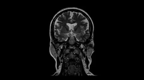 Computed tomography of the brain Stock Footage