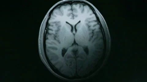 Computed tomography of the brain Video stock 33819234