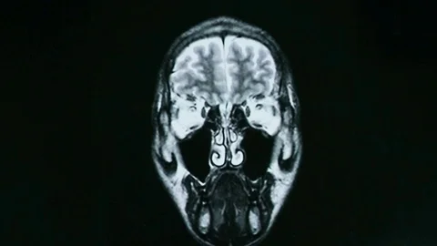 Computed tomography of the brain Stock Footage 69902491