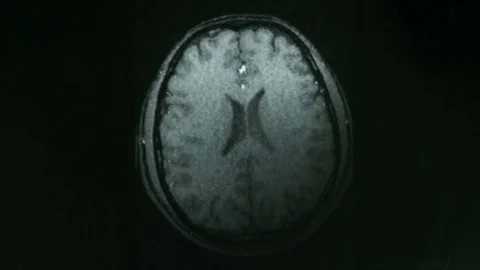 Computed tomography of the brain Stock Footage 69902631