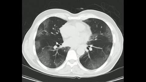 Computed Tomography of the chest in a confirmed case of COVID-19 (Corona virus) Stock Illustration