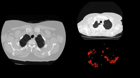 Computed tomography of covid-19 in 3d Stock Footage 128696810