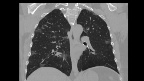 Computed tomography of covid-19 Stock Footage 128692504