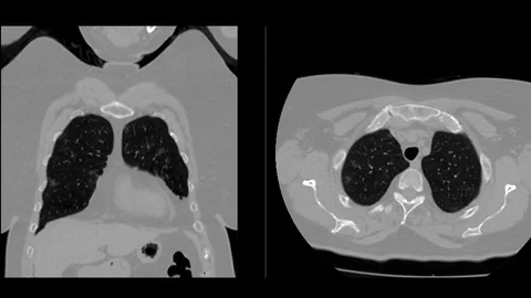 Computed tomography of covid-19 Stockbeeldmateriaal 128697001