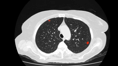 Computed tomography of covid-19 Stockbeeldmateriaal 128697116