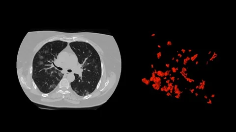 Computed tomography of covid-19 segmented in 3d Stock Footage 128696320