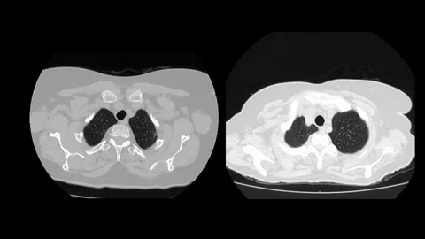 Computed tomography of covid-19 segmented Stock Footage 128696625