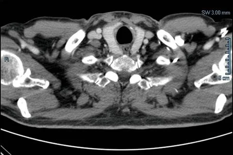 Computed tomography (CT scan) chest of a male patient, top view. Stock Photos