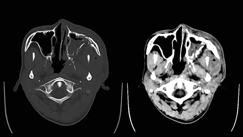 Computed tomography (CT scan ) of Orbit,A male 26 year old Traffic accident D Stock Footage 158902125