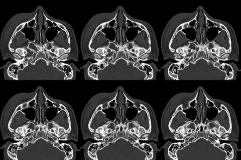 Computed tomography (CT scan ) of Orbit Displaced fracture at lateral and med Stock Photos