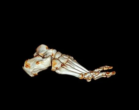 Computed Tomography of the Foot Stock Illustration